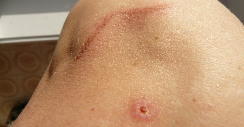 Pure Methods To Get Rid Of Undesirable Scars